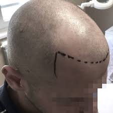 NPM紋髮/頭皮紋繡/紋髮際線/飄髮