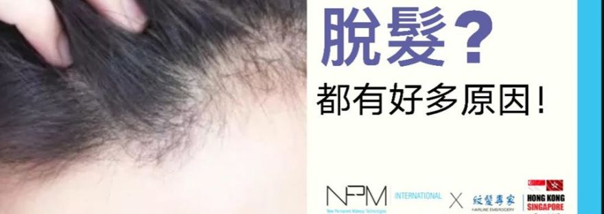 NPM紋髮 禿頭 脫髮