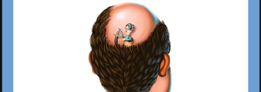 NPM紋髮 禿頭 脫髮