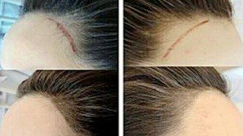 NPM紋髮 脫髮