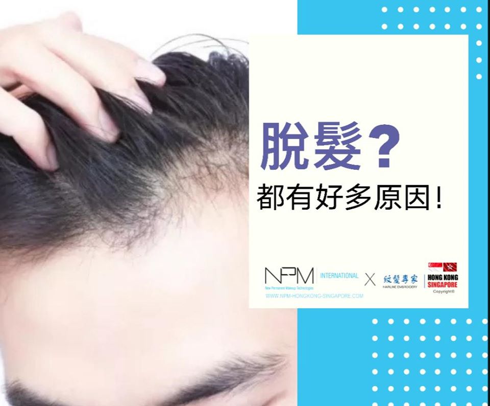 NPM紋髮 禿頭 脫髮